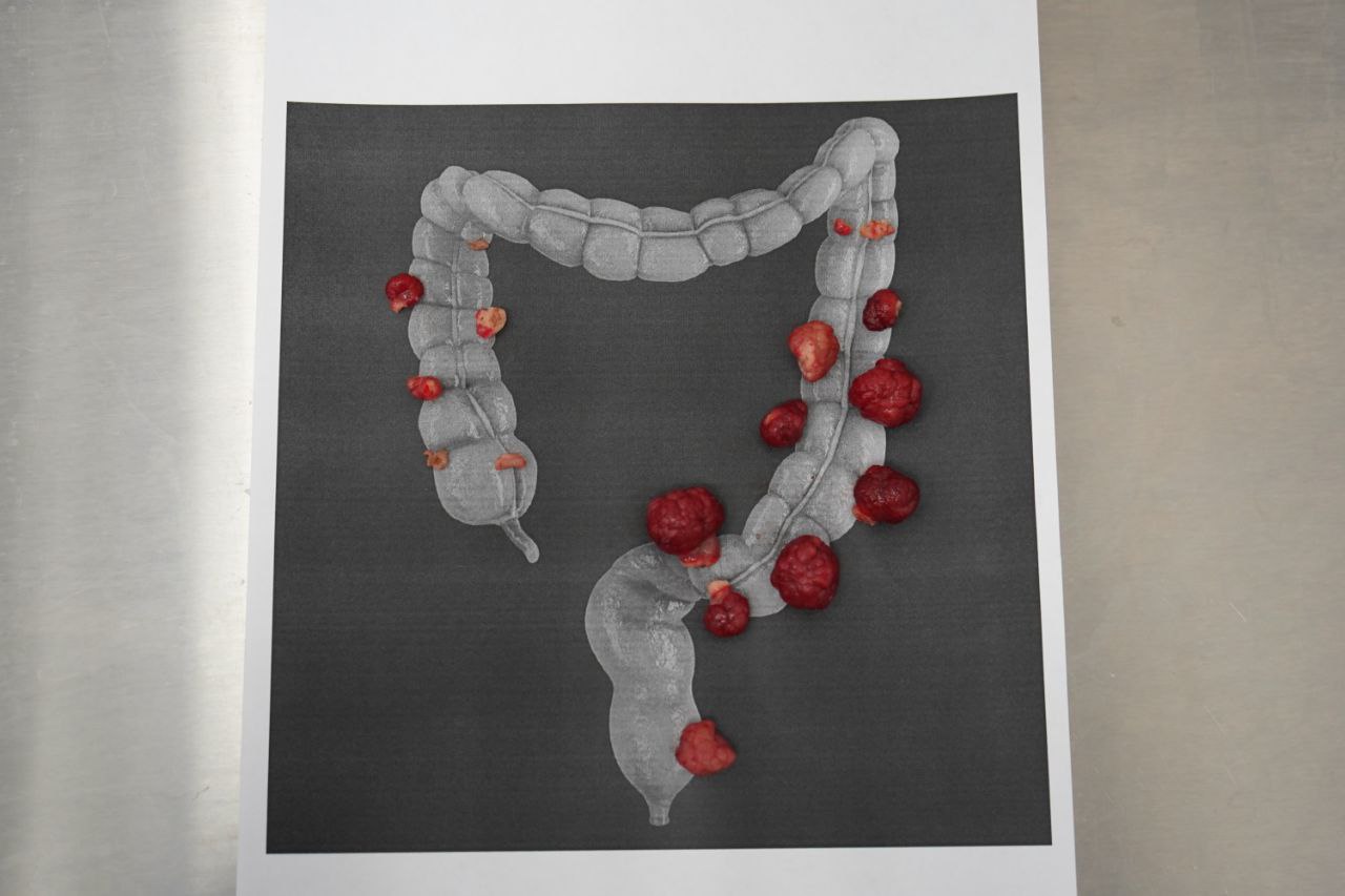 В Онкоцентре прооперировали пациентку с 40 опухолями В Онкоцентре прооперировали пациентку с 40 опухолями