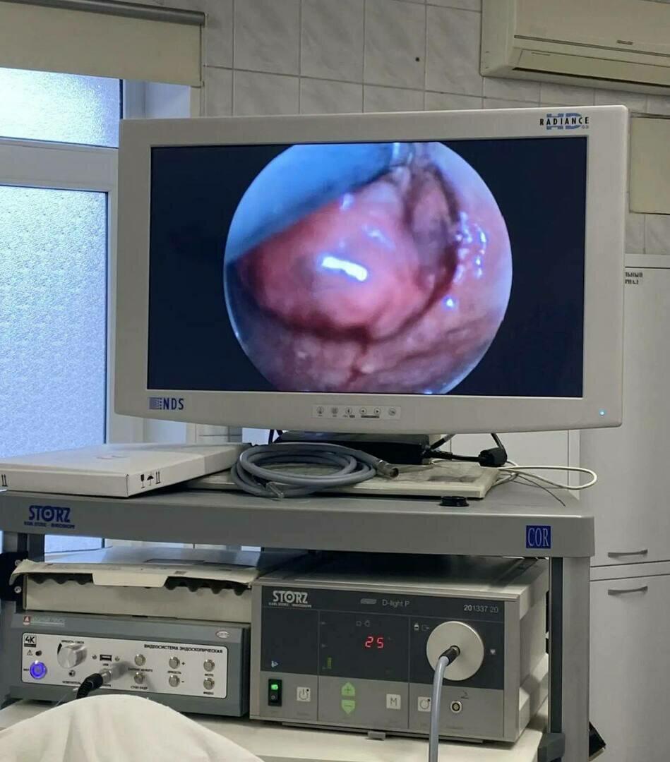 В Калининградской областной клинической больнице впервые провели операцию по удалению опухоли нижнего отдела кишечника без разрезов на животе В Калининградской областной клинической больнице впервые провели операцию по удалению опухоли нижнего отдела кишечника без разрезов на животе