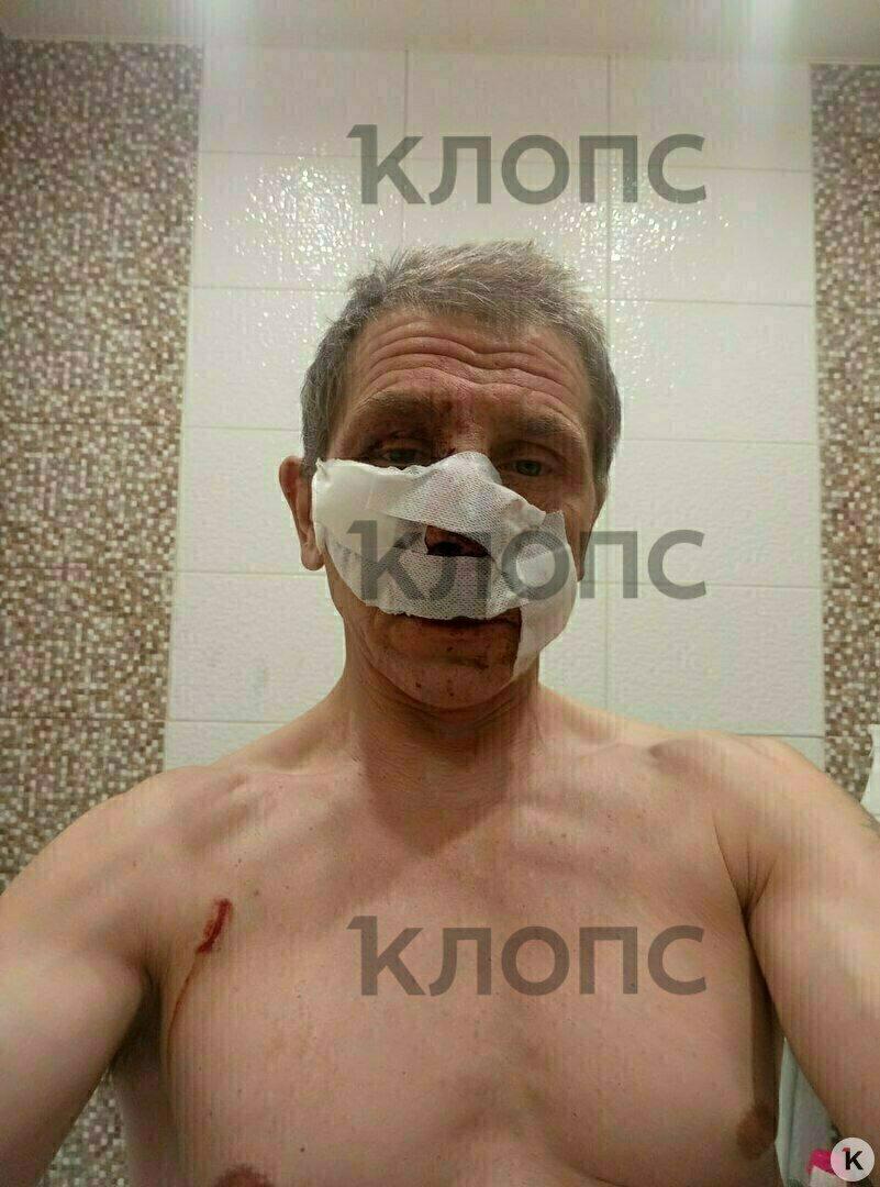 В Калининграде питбуль набросился на знакомого хозяйки и разорвал ему лицо, едва не откусив нос В Калининграде питбуль набросился на знакомого хозяйки и разорвал ему лицо, едва не откусив нос