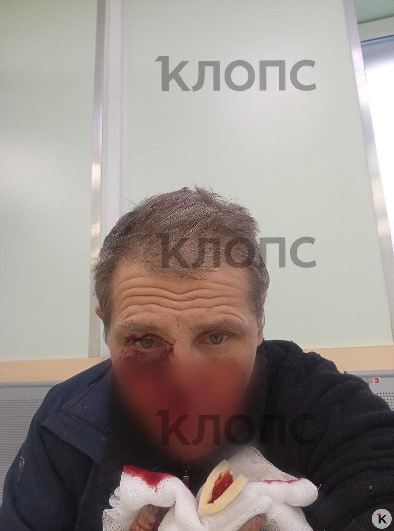 В Калининграде питбуль набросился на знакомого хозяйки и разорвал ему лицо, едва не откусив нос В Калининграде питбуль набросился на знакомого хозяйки и разорвал ему лицо, едва не откусив нос