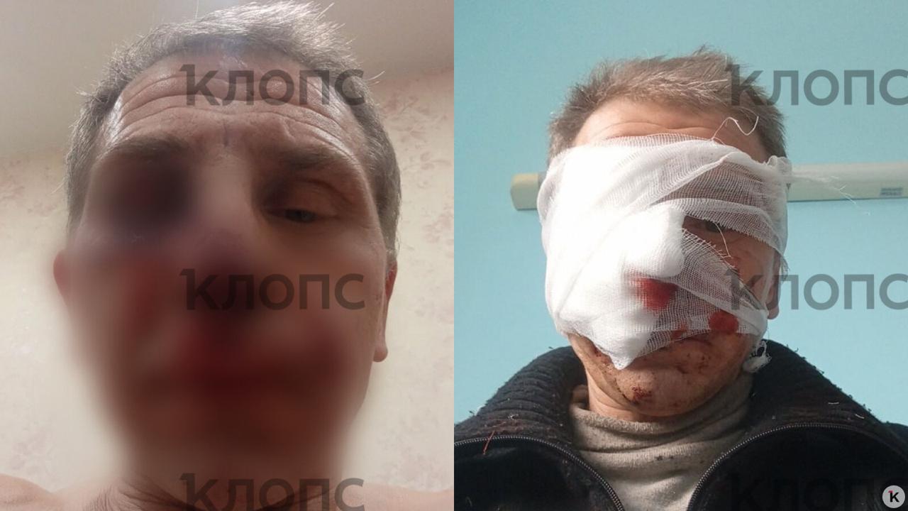 В Калининграде питбуль набросился на знакомого хозяйки и разорвал ему лицо, едва не откусив нос