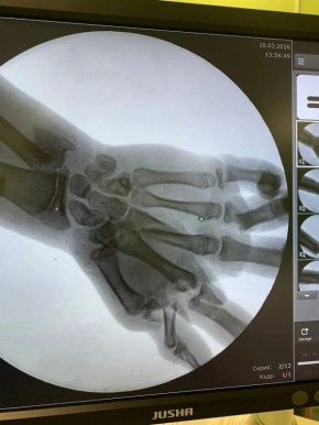 Врачи в Калининграде по частям собрали кисть ребенка, в руках которого взорвался снаряд