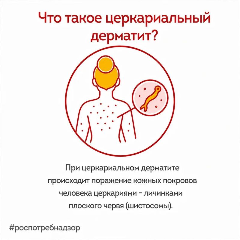 Роспотребнадзор предупреждает о рисках заражения церкариальным дерматитом (зуд купальщика), вызванным личинками шистосомы Роспотребнадзор предупреждает о рисках заражения церкариальным дерматитом (зуд купальщика), вызванным личинками шистосомы